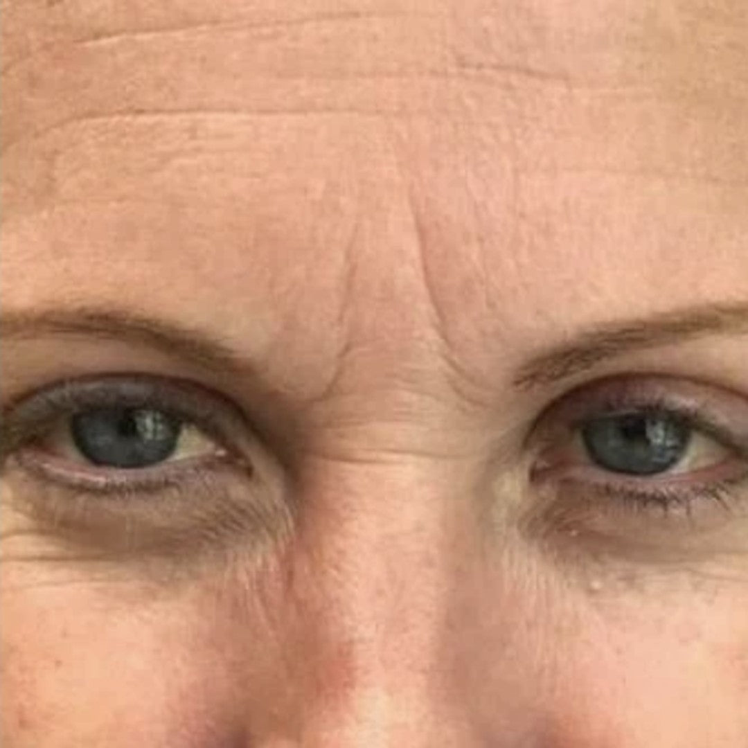Frente y contorno de ojos antes de usar LiftGo