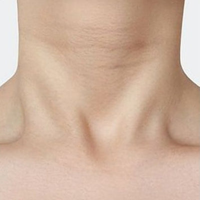 Cuello con líneas marcadas