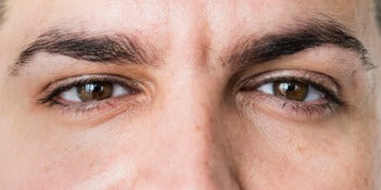 Primer plano de unos ojos con los párpados hinchados
